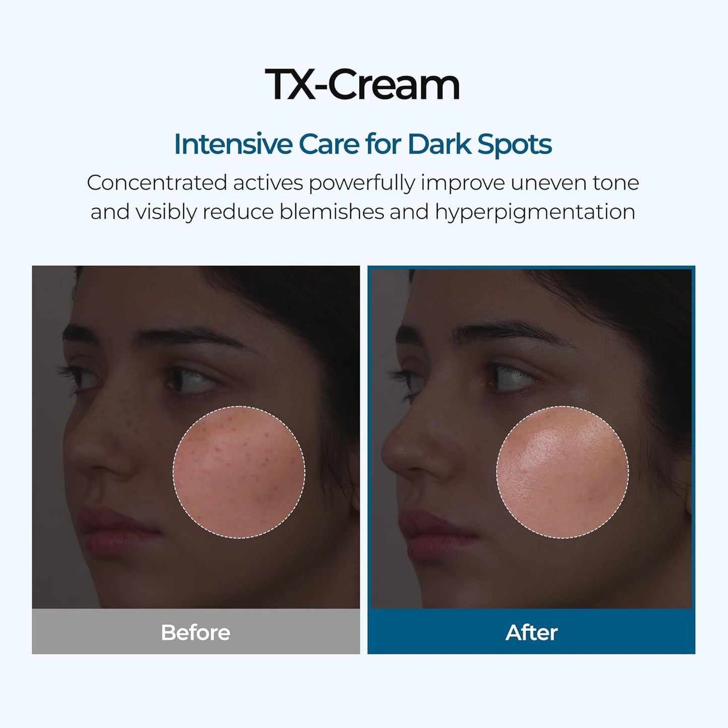 Tranexamic Acid Cream - Dark Spots & Hyperpigmentation