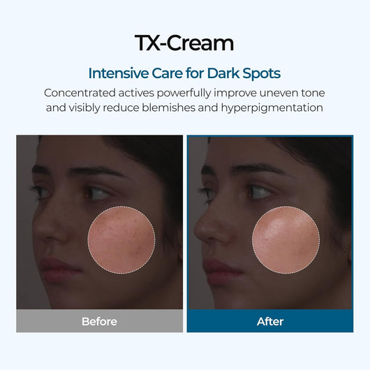 Tranexamic Acid Cream - Dark Spots & Hyperpigmentation